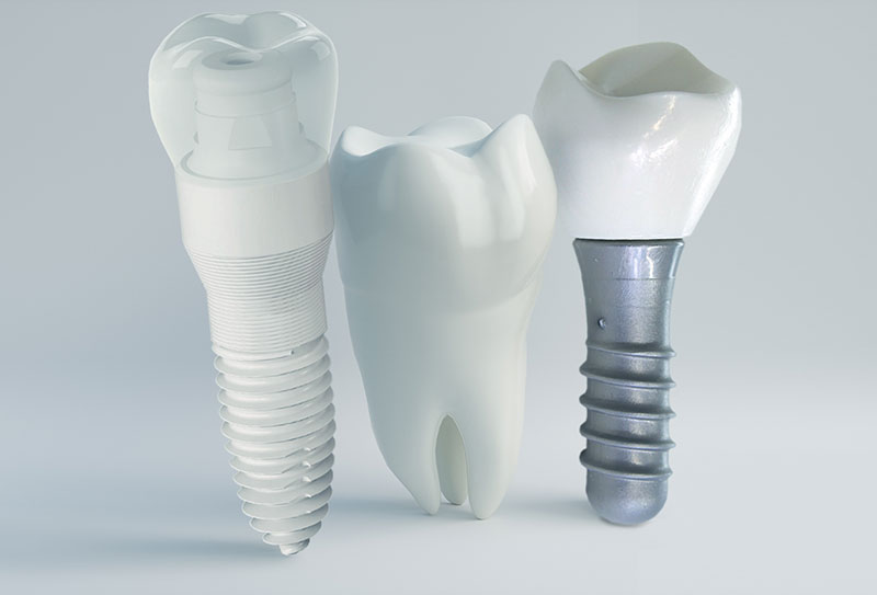 Photo of dental implants