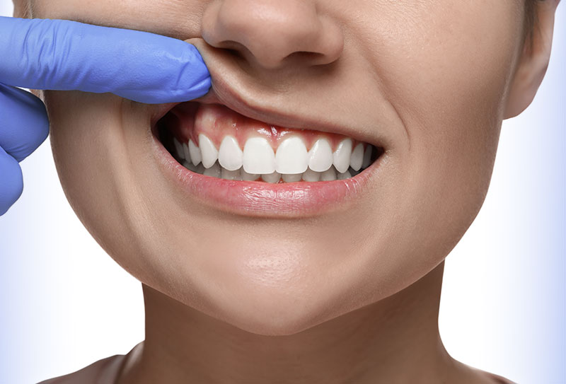 Foto Implantate