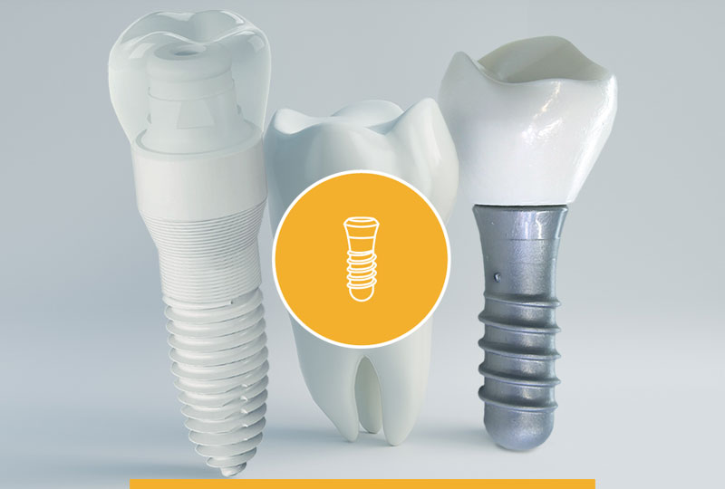 Photo of dental implants